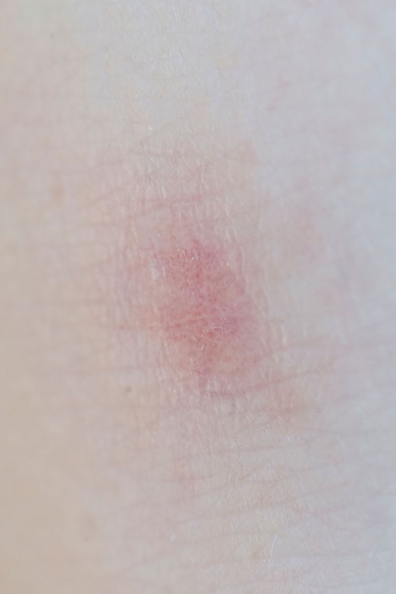 Skin reactions show up after contact alone